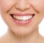 Top 5 Common Misconceptions About Dentist And Dental Treatments